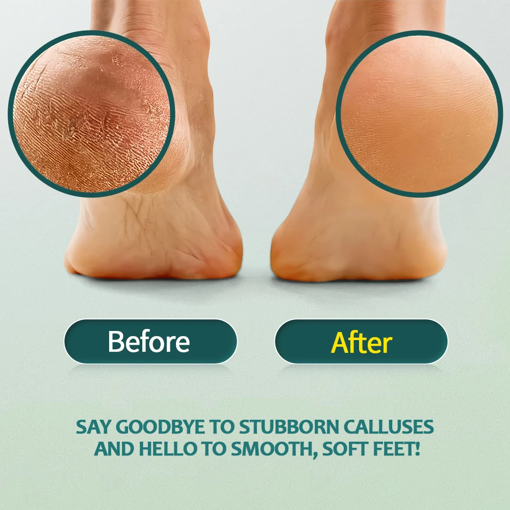 Professional Callus Remover for Feet Extra Strength Gel & Rasp Foot File Kit Dead Skin Remover Cracked Heels Dry Skin